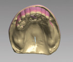 Figure 1  The digital design of an RPD begins with scanning the master cast and performing virtual blockout and waxing with proper missing teeth and abutment teeth.