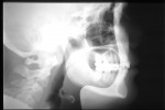 Figure 11  Posttreatment cephalometric radiograph. Note normal occlusal plane.