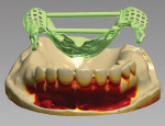Figure 18  The digital RPD framework is virtually raised from the cast for visual checking of the intaglio or tissue surface and tooth surface of clasps and rests.