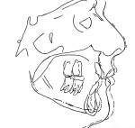 Figure 14  Pre- and postsuperimposition of tracing on anterior cranial fossa, displaying counterclockwise rotation of the mandible.