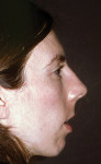Figure 16  Profile view of patient reveals an imbalance of the soft-tissue drape of the face. The patient has an obtuse nasolabial angle. Note the unesthetic junction of the upper lip to the nose. The patient displays hyperactivity and bulging of the