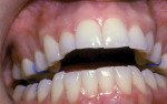 Figure 20  Intra-oral view of this severe open bite and lingual version of the crowns of the buccal dentition.