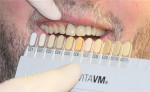 Figure 4  Preparation for the ceramic layering. The effect chroma ceramic, which is to be mixed with the dentin particularly in the cervical third, is determined using the shade tabs.