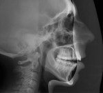 Figure 21  Cephalometric radiograph reveals an AP maxillary deficiency, posterior vertical maxillary deficiency, anterior vertical maxillary excess, severe AP mandibular deficiency, high occlusal angle, and decreased airway (oropharyngeal and nasal).