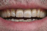 Figure 7  The result after the definitive seating. Appropriate characterizations were added to obtain a harmonious shade match with the adjacent natural teeth and the antagonists. Professional tooth cleaning was planned for a later time.