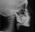Figure 23  Posttreatment cephalometric radiograph. There is the dramatic improvement in the soft-tissue drape of the face and the balance and proportionality of the posterior facial height in relation to the lower anterior facial height and anterior