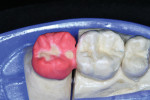 Figure 11  Occlusal modifiers help to create a more natural appearance.