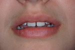 Figure 3  The patient’s teeth in repose indicated she had sufficient tooth display and, therefore, tooth lengthening would be unnecessary.