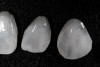 Figure 7a  Alternating osteotomes with variable conicity used to perform the alveolar remodeling in the area of tooth No. 15.
