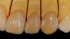 Figure 10  Posttreatment radiograph, after cementation of the final restorations.