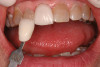 Figure 15a  Final implant-supported PFM restorations.