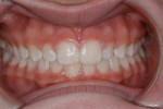 Figure 36  The patient’s teeth with her lips retracted.