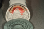 Figure 1  Putty matrix of the waxed denture tooth set-up.