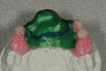 Figure 3  The waxed-up framework with hollowed out posterior teeth.