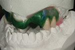 Figure 4  The waxed-up framework with hollowed out posterior teeth.