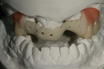 Figure 7  A light-cured composite resin was placed in the gingival areas of the posterior region.