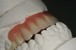 Figure 9  The finished and polished denture teeth displayed on the framework.