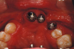 Figure 11  An intraoral photograph of the copings using Rhein83 Equator Castable Attachments.