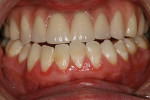 Figure 12  An intraoral photograph of the finished case.