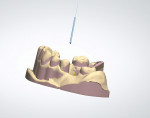 Figure 1  The 3Shape virtual surveyor enables a technician to precisely locate the desired path of insertion when digitally designing a removable partial denture framework.