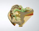 Figure 3  A digitally designed removable partial denture framework is virtually created and ready to add sprues for perfactory pattern printing.