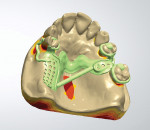 Figure 4   The maxillary is virtually designed as a waxed framework with support bar.