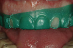 Figure 16  The maxillary reduction guide was used to reduce the out-of-arch-form dentition.
