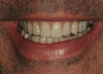 Figure 21  View of the maxillary provisionals in a natural smile.