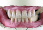 Figure 4  The front teeth were set up in the mandible and maxilla with respect to esthetic principles.