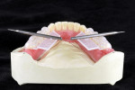 Figure 9: The wings at the occlusal part of the setup support make possible an optimal check of the occlusal alignment in the transverse.