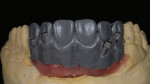 Figure 3  For this case, a gingival component was necessary for inclusion in the final restoration.