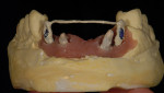 Figure 7  Temporary abutments were used to support the provisional base.