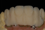 Figure 14  The gingival section of the case was cut back for pink composite, which was bonded to the acrylic resin.