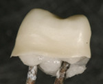 Figure 5  The inVizion crown substructure was milled from shaded and sintered VITA YZ zirconia.