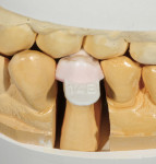 Figure 12  The coping with dentin-filed mold is articulated into the maximum intercuspation position.