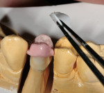 Figure 14  The flexible occlusal mold is removed from the coping.