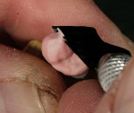 Figure 16  A slight cut-back is performed and proximal voids are filled with dentin material.