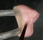Figure 17  A slight cut-back is performed and proximal voids are filled with dentin material.