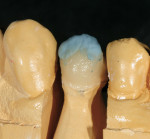Figure 20  A thin layer of gray enamel is placed incisally and wrapped onto the mesial and distal marginal ridges.