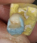 Figure 21  Occlusal characterizations are applied using Akzent stains and the coping is fired.