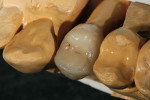 Figure 22  Occlusal view of the fired coping.