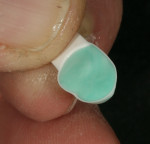 Figure 24  The occlusal mold is lubricated and filled with the proper shade of enamel porcelain.