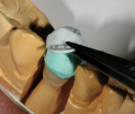 Figure 27  The occlusal mold is carefully removed.