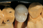 Figure 33  Occlusal view of the fired crown.