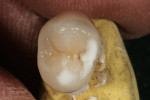 Figure 36  Additions to centric are carried out using Effect Opal and Correction-1 material.