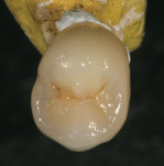 Figure 38  Occlusal view of the glazed crown.