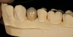 Figure 44  Buccal view of the final crown on the solid cast.