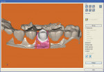 Figure  2  The 3-D view displays the abutment, gingival ridge, bite registration, and adjacent teeth.