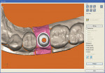 Figure  3  Occlusal view of the digital design