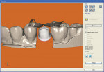 Figure  5  The abutment design with opposing teeth modeled